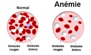 L anemie pernicieuse